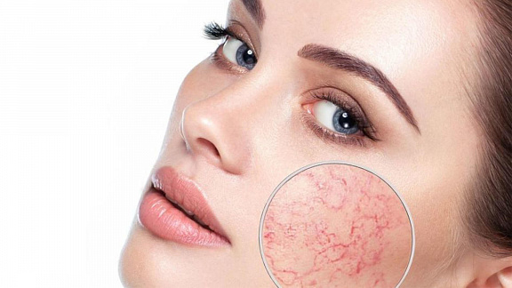 «Розацеа и Купероз» - Аданье Этель